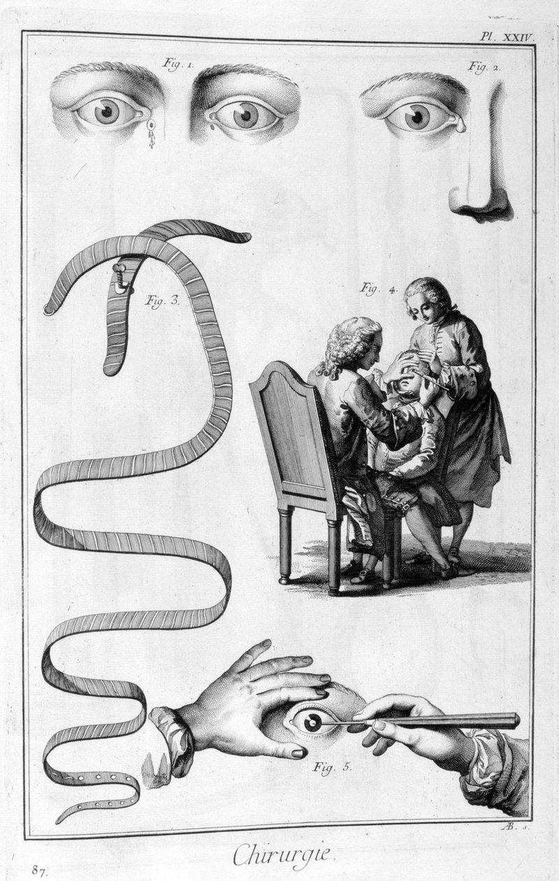 Eye Surgery, 1751-1777 by Unbekannt