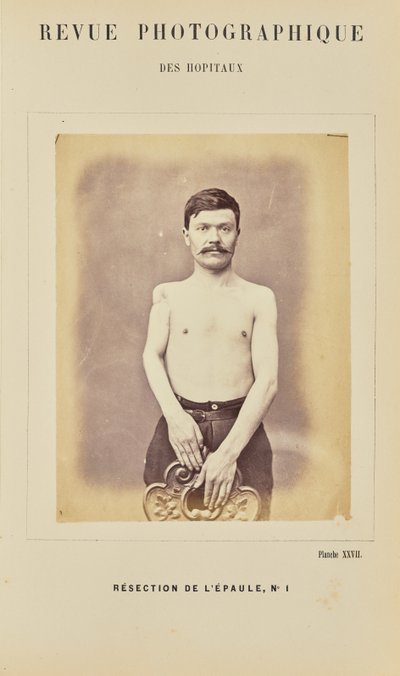 Resection of the Shoulder, Number 1 by Arthur de Montmeja