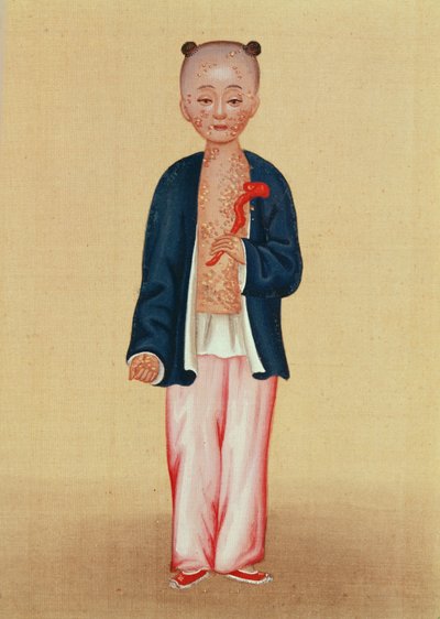 Child with smallpox by Chinese School