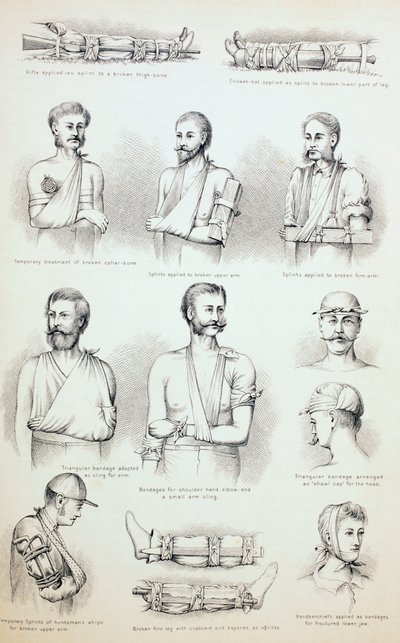 Temporary Treatment of Fractures by English School