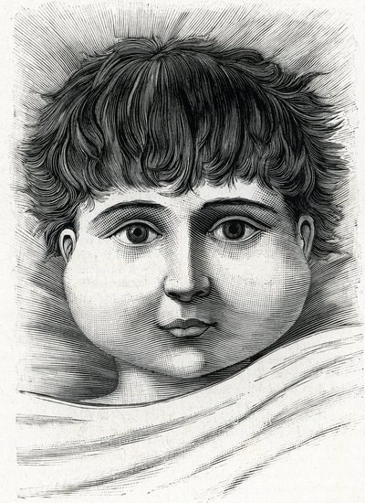 Child with mumps disease (engraving) 1888 by French School