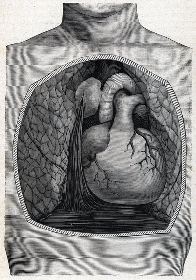 Aneurysm rupture 1888 by French School