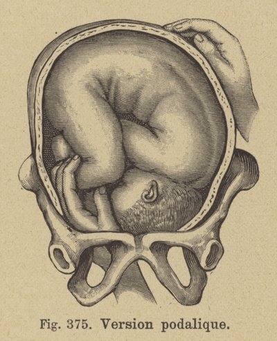 Podalic Version During Childbirth by German School