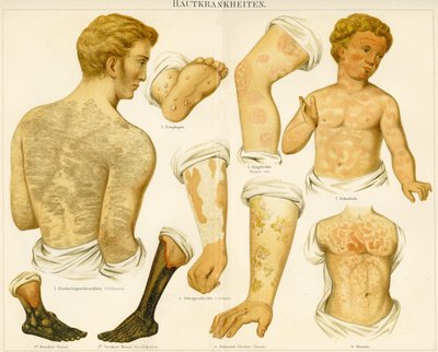 Skin Disorders, c.1890 by German School