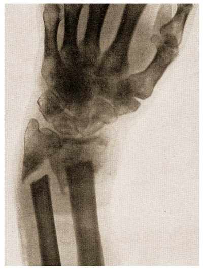 X Ray of a Fractured Wrist by German School