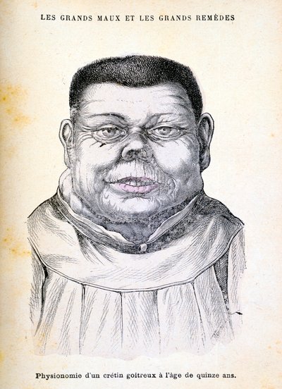 Cretin Aged 15 by Unbekannt