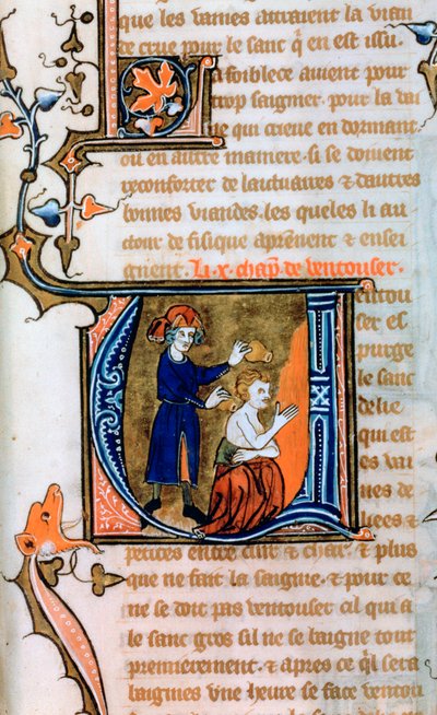 Cupping, 14th Century by Unbekannt