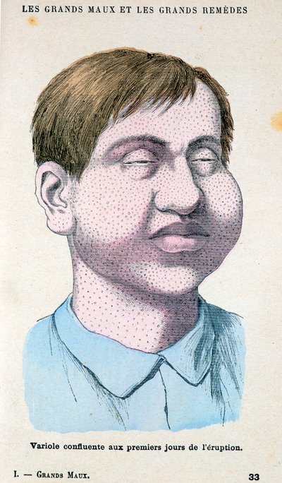 Smallpox Victim, c1890 by Unbekannt