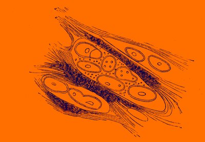 Cross section of a melanoid cancer by Unbekannter Künstler