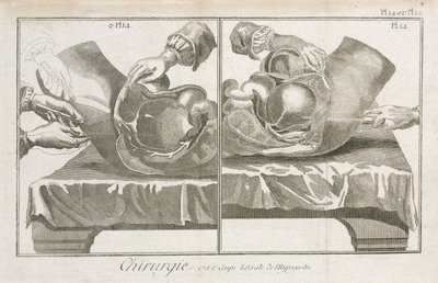 Equipment, Early-Modern Abdominal surgery by Unbekannt