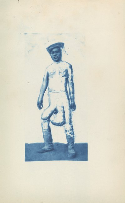 Elephantiasis by Unknown 19th Century