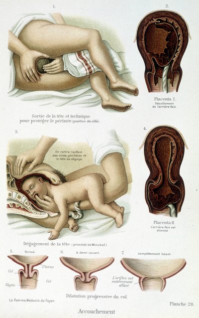Childbirth - scientific board, late 19th century by Unknown artist