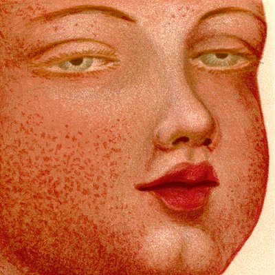 Eruptive Fevers: Scarlatina or Scarlet Fever by Unknown artist