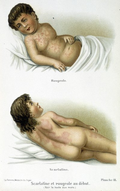 Scarlet Fever and Measles - 19th Century by Unknown artist
