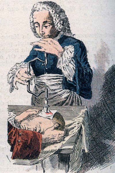 The Trepanation. 18th century print. by Unknown artist